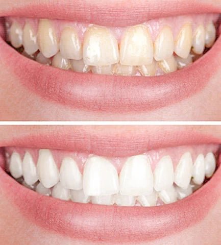 1+1 FREE | SmilePro™ - Teeth Brightener (Buy 1 Get 1 FREE ) - | Zavonix