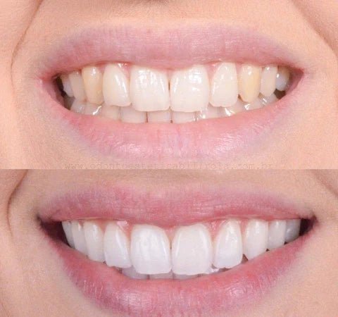 1+1 FREE | SmilePro™ - Teeth Brightener (Buy 1 Get 1 FREE ) - | Zavonix