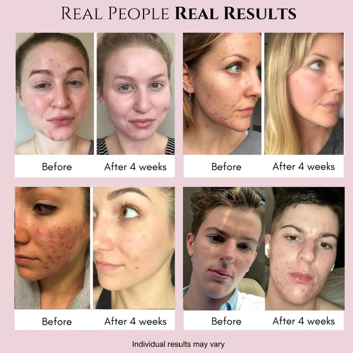 PoreVac™ — Unleash Radiant Skin That Turns Heads Instantly
