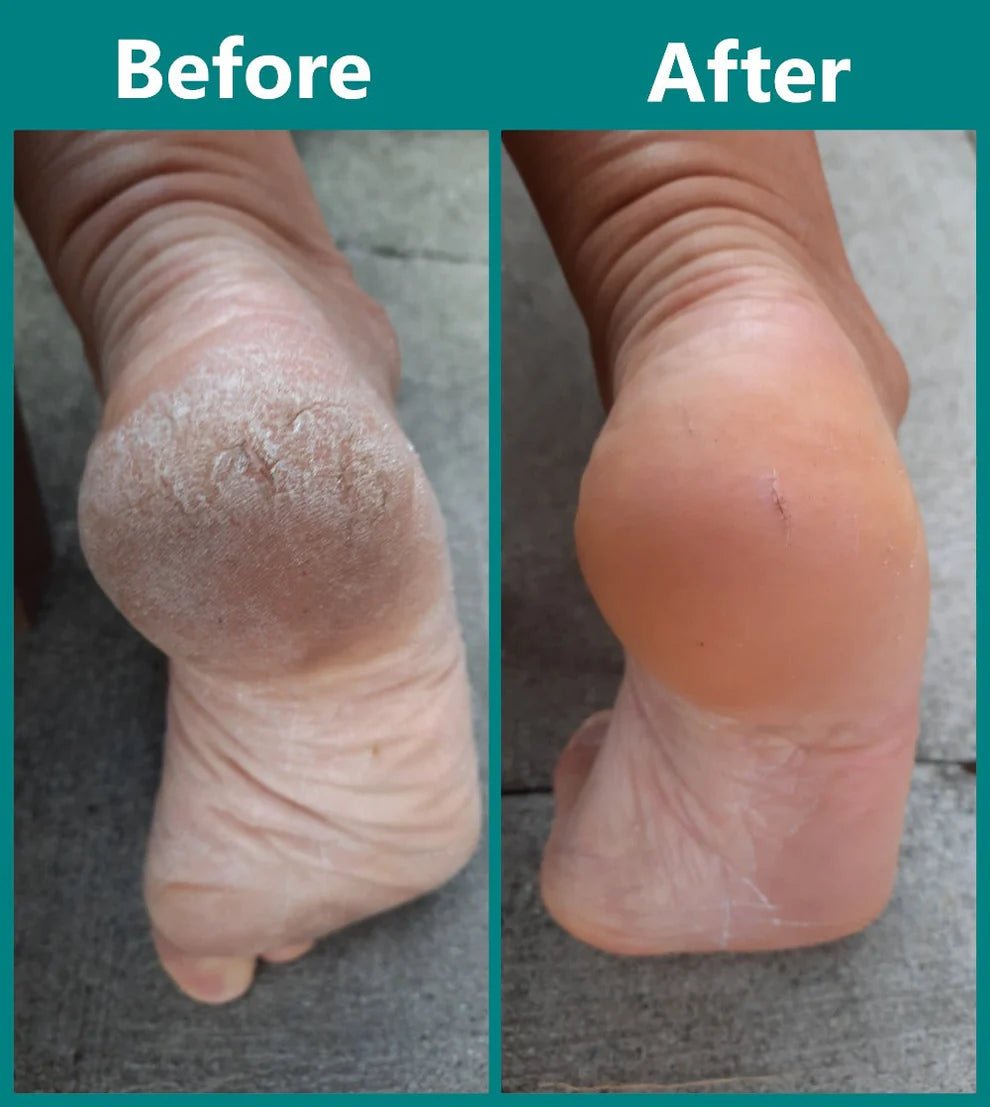 Foot Care Device for Gentle Exfoliation | Waterproof with Dual Roller Strength and 100-Minute Battery Life - 5